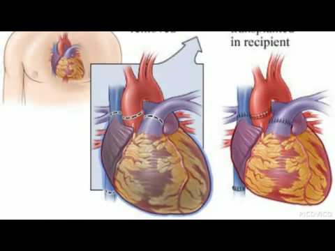 Heart Transplant Surgery India