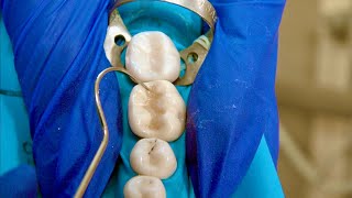 Class 1 Resin Composite Restoration