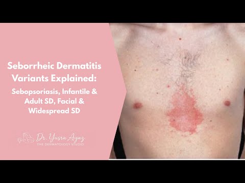 Lecture 2: Seborrheic Dermatitis Variants Explained
