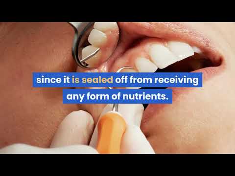 Can Biomimetic Dentistry Prevent Root Canals? Dentist Explains
