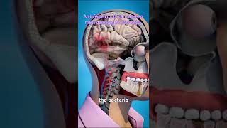 An infected tooth can cause many damage if not treated #dentistexplains #dentalproblems