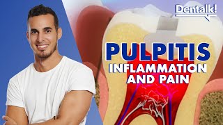 TOOTHACHE? It could be PULPITIS - Tooth pain RELIEF and CAUSES of inflamed pulp | Dentalk! ©