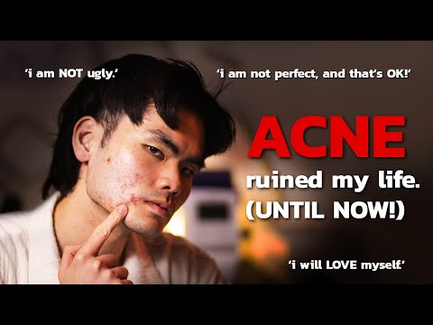 overcoming INSECURITIES - SEVERE ACNE and SELF-ESTEEM struggles