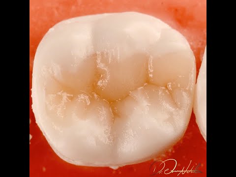 Class II Composite build up in Lower First Molar (Centripetal and Cusp by Cusp build up techniques).
