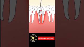 #dentistryknowledge#dentist#short#root#canal#tretment#save#tooth#youtubeshorts#new#wolrd#treding#new