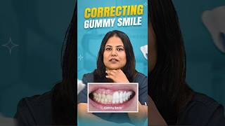 Correcting Gummy Smile | Senthil Dental Care