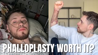 My FTM Phalloplasty Story: 3 Months Later and The Complications I've Had