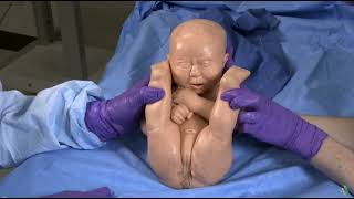 Baby in Breech Delivery