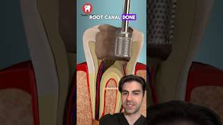 Why Root Canals Aren't As Bad As You Think