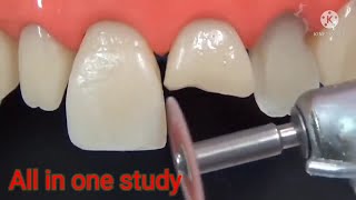 Direct restoration of front tooth in 2 minutes. Anterior tooth restoration. Tooth restoration.
