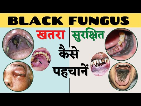 Black fungus infection (Mucormycosis) in Covid / कैसे पेहचाने ब्लैक फंगस इन्फेक्शन को