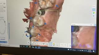 Digital Impression For Implant Crown