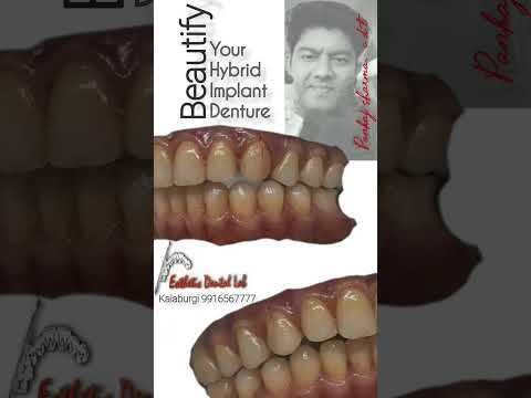 hybrid implant denture with composite characterization#kalaburagi #dentaltechnician #indiandentist