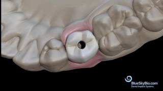 Screw Retained Crown Chairside Bonding