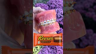 Halloween Braces That’ll Make You Scream! #braces #dentist #shorts #halloween
