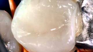 Bioclear - Replacing old almalgam