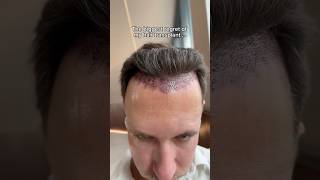 So sad… #hairtransplant #beforeandafter