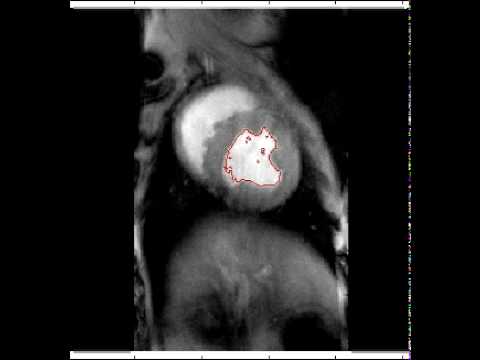 modifiedChanVese_heartFullLowerRight.avi