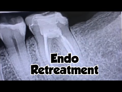 Endodontic Retreatment of tooth number 19