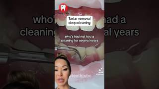 Deep cleaning tartar removal #shorts