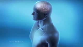Deep Brain Stimulation (DBS): Stages of Surgery