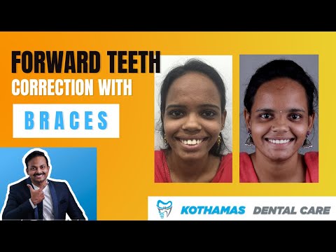 Forward Teeth Correction With Braces - by Dr.Praneeth Kumar
