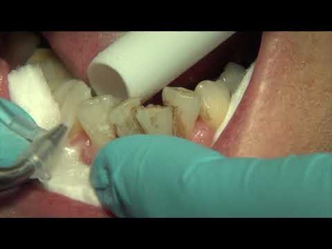 Cosmic Clean Airflow #brighterteeth #cleanteeth #whitersmile