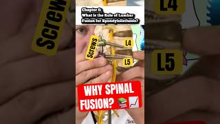 Why “Cages” in Spinal Fusion (Part 6)