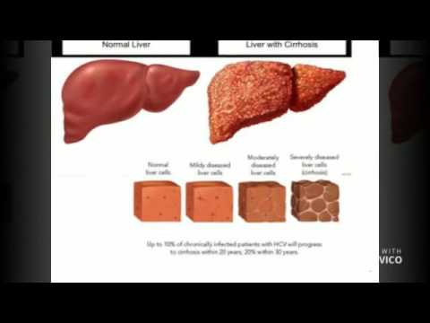 Liver Cancer Treatment