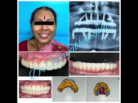 #implantcastle #implantcastleperambur #implantcastlechennai #dentist #drvijayabharathi #druvashri
