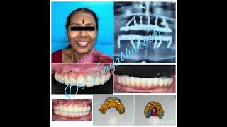 #implantcastle #implantcastleperambur #implantcastlechennai #dentist #drvijayabharathi #druvashri