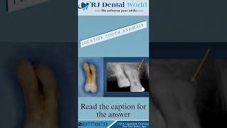 Identify Tooth Anomaly....HypercementosisIt is excessive deposition of cementum on the tooth roots.