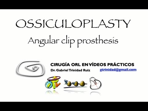 ANGULAR CLIP OSSICULOPLASTY