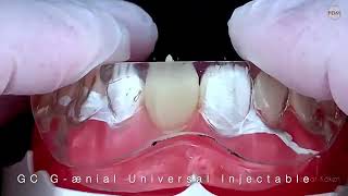 Injection Moulding Technique with G-ænial Universal Injectable and GC Exaclear by Serhat Köken