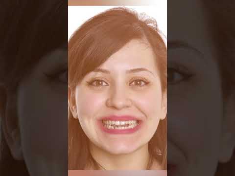 Tongue Thrusting क्या है? | Tongue Thrusting को कैसे रोकें? | Tongue Thrusting Habit | Dr Navita