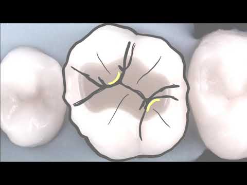 Upper First Molar Anatomy Guidelines..