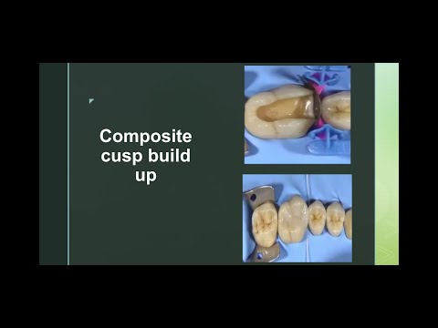 Composite cusp build up #stepbystep