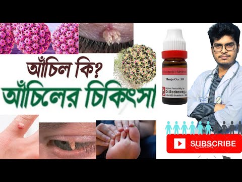 আঁচিলের সমস্যা ও সমাধান। #আঁচিল #Warts Problem  and Treatment .