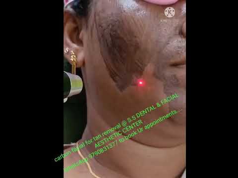 LASER CARBON PEEL