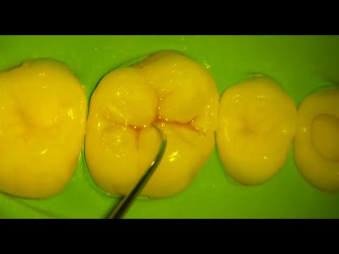 Upper First Molar Composite Restoration. Cusp by Cusp buildup technique.