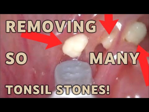 REMOVE so many TONSIL STONES! | AIM 14