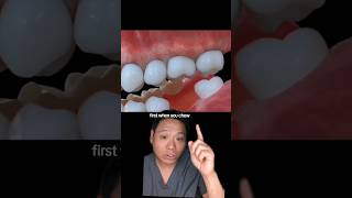 What Can Happen To Your Mouth When You Lose a Tooth!? 😁🦷 #teeth #missingtooth #tooth #toothless