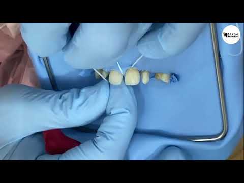 Direct Restoration 🦷🦷