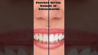 ✨Importance of a Dog Leg Preparation Galip Gürel✨1  Hides the Margin for EstheticsThe dog leg
