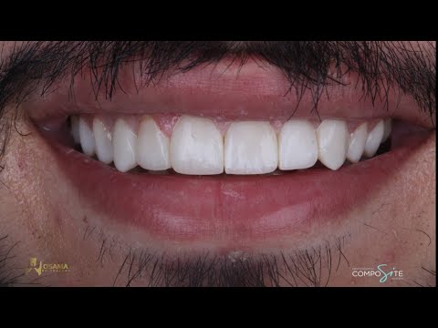 COMPOSITE RESIN  VENEERS SMILE MAKEOVER