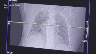 TB cases identified in Manchester, Nashua