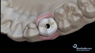 Screw Retained Crown Laboratory Bonding