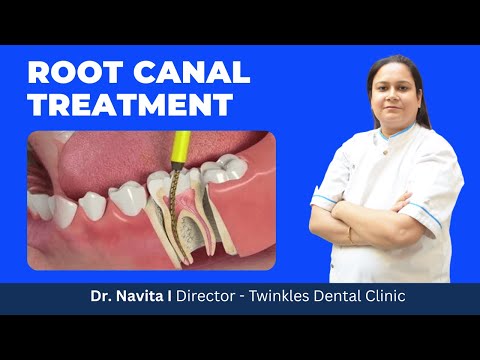 Root Canal Treatment क्या होता है? I Root Canal Video in Hindi I RCT