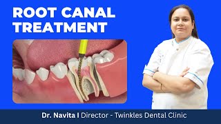 Root Canal Treatment क्या होता है? I Root Canal Video in Hindi I RCT
