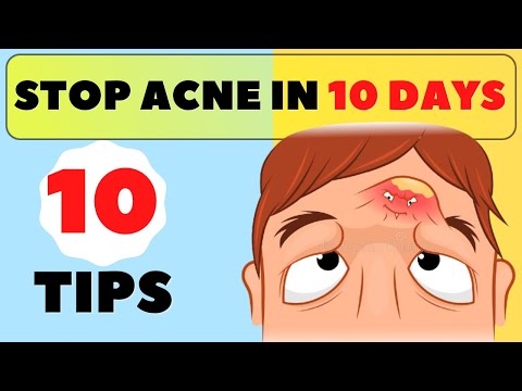 How to get rid of Acne / How to get rid of Pimples / Treat the root causes of acne